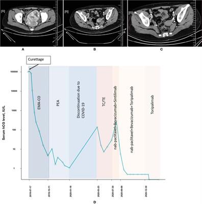 Effectiveness and Safety of Toripalimab Combination Therapies for Patients With Chemo-Resistant Choriocarcinoma